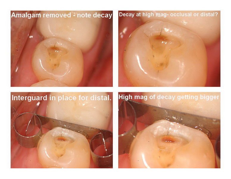 Amalgam removal 2_resize.jpg